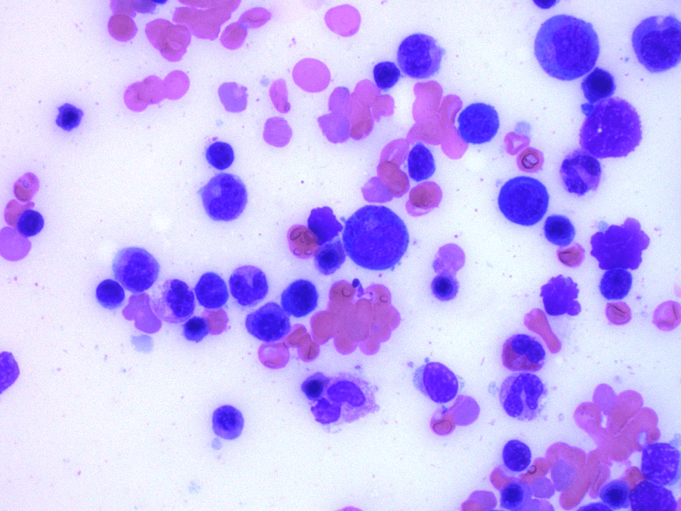 Bone-marrow-biopsy-showing-mixed-elements-(erythroid,-myeloid,-lymphoid).