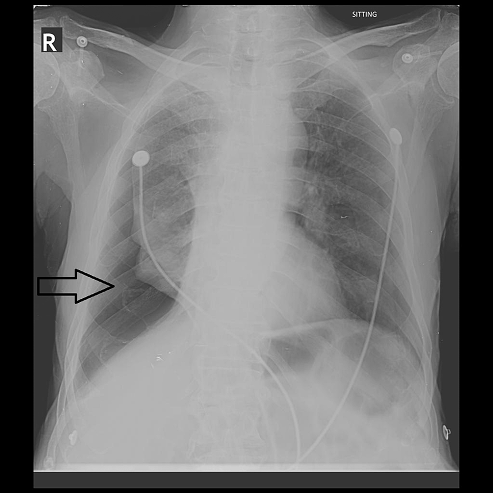 Right-sided-pneumothorax-(black-arrow)-reported-by-both-the-resident-and-the-attending-radiologist