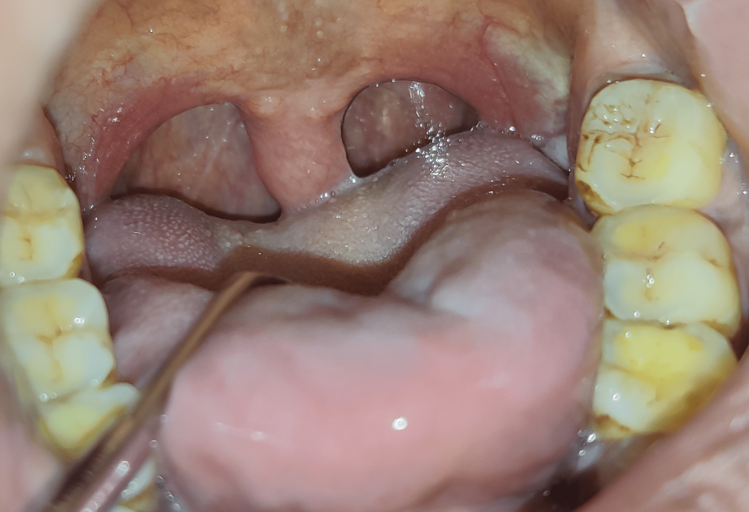 Cureus | Obstructive Sleep Apnea: A Case Report | Article