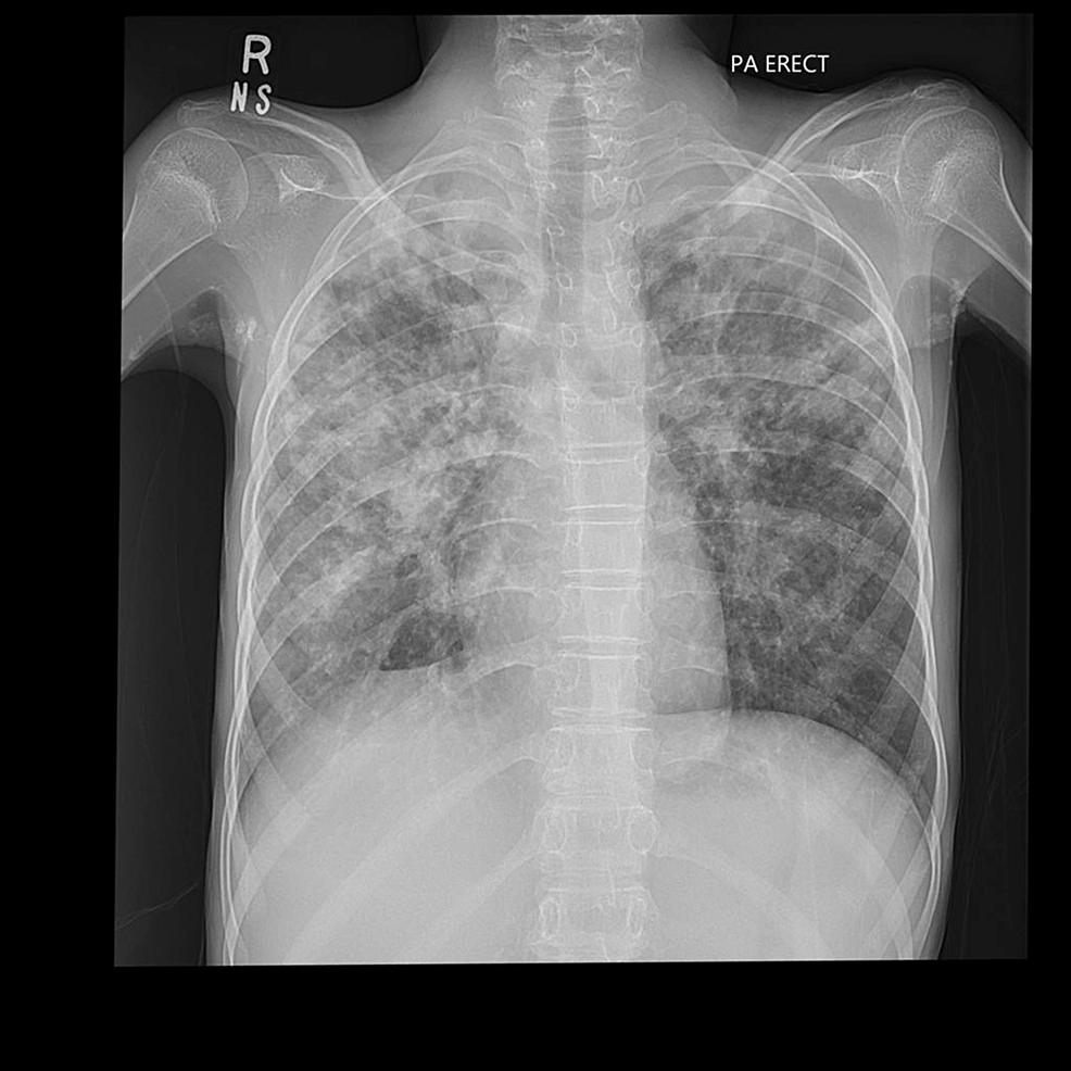 No-pneumothorax-reported-by-both-the-resident-and-the-attending-radiologist