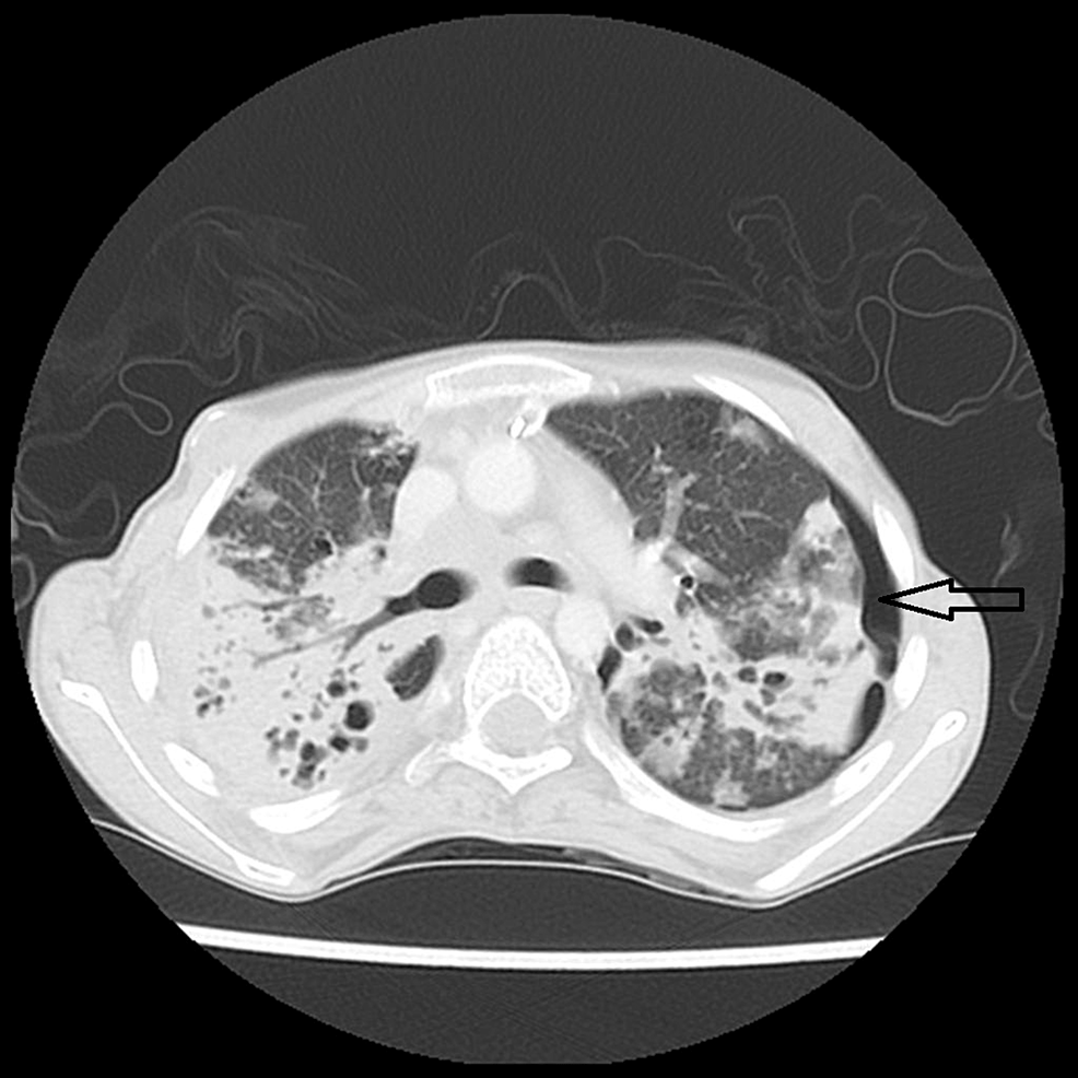 Subtle-left-sided-pneumothorax-(black-arrow)-not-detected-on-the-previous-radiograph-by-both-the-resident-and-the-attending-radiologist