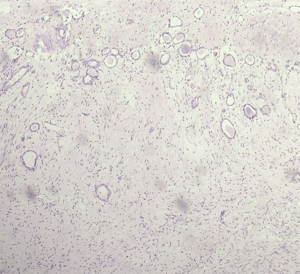 Huge Renal Angiomyolipoma Mimicking A Renal Cell Carcinoma A Case Report Cureus