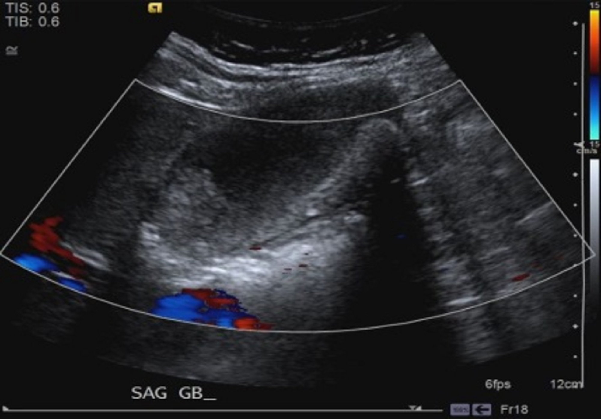 Cureus Gallbladder Carcinoma The Difficulty Of Early Detection A