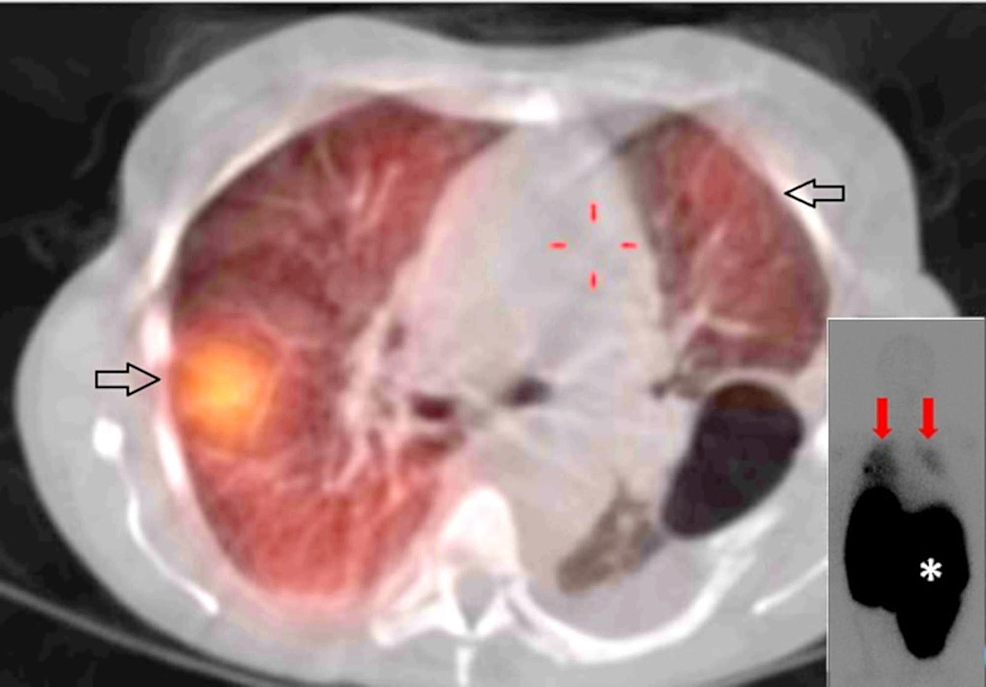 Cureus A Year Old Woman With Myelofibrosis And Massive Hemothorax Due To Primary