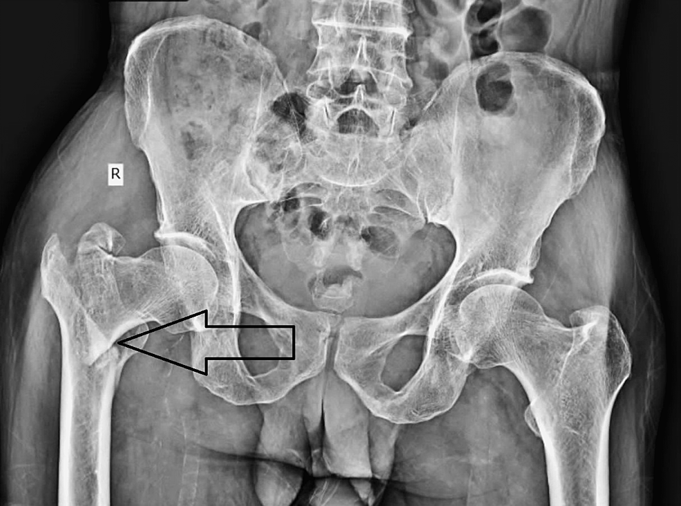 -Pre-operative-radiograph-of-the-pelvis-and-both-hips-showed-an-intertrochanteric-fracture-of-the-right-femur.