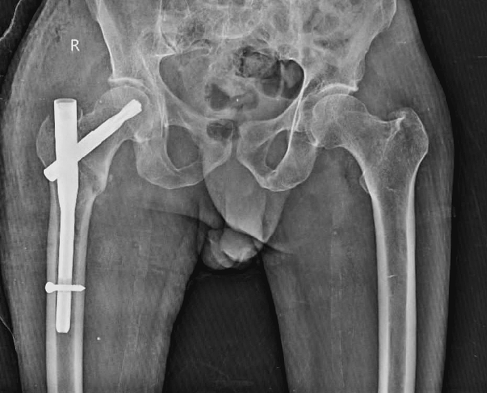 Post-operative-x-ray-of-right-femur.