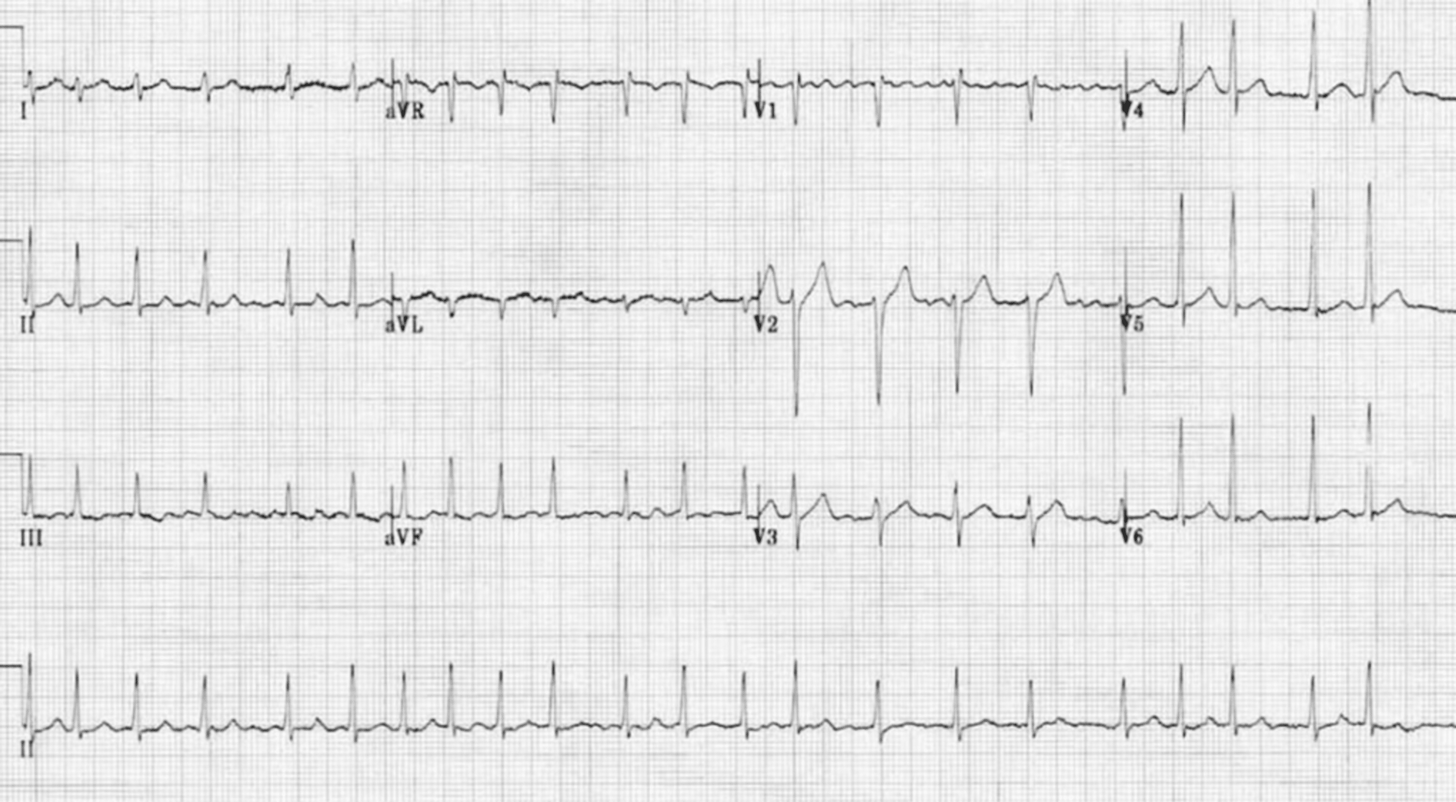 Cureus | Transseptal Puncture Through an Interatrial Septum With ...