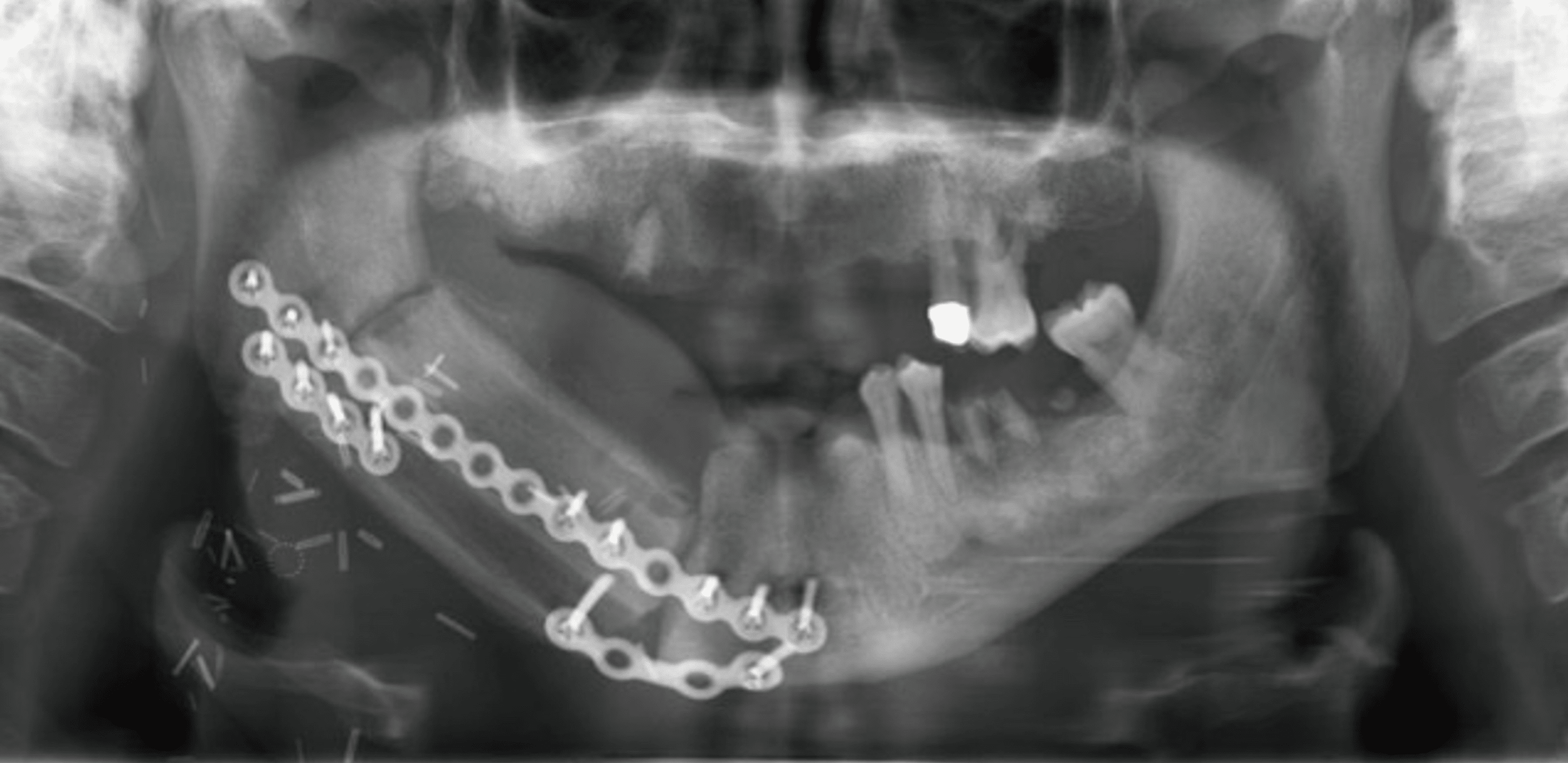 Cureus | Approach For Mandibular Reconstruction Using Vascularized Free ...