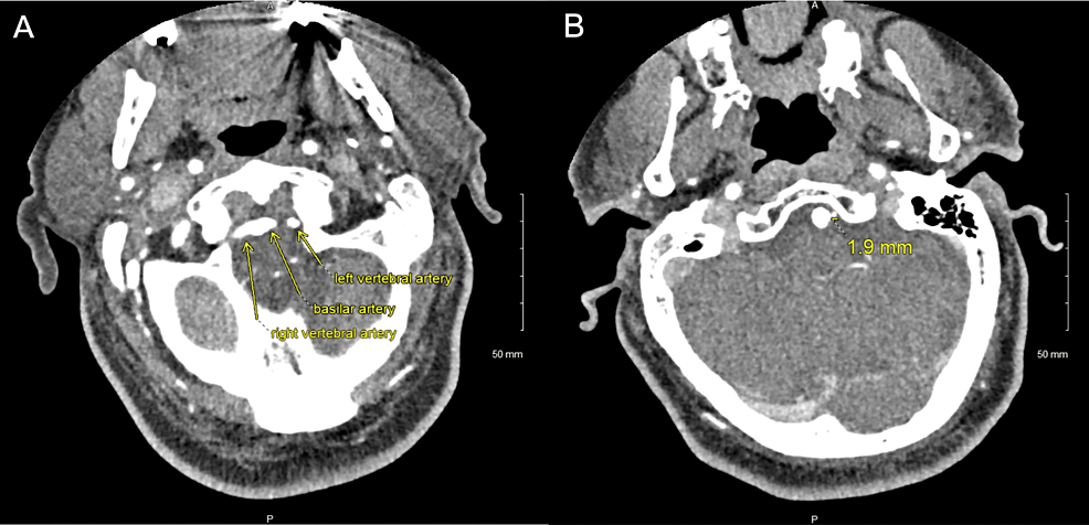 Lateral Medullary Syndrome Due To A Hypoplastic Vertebral Artery Cureus