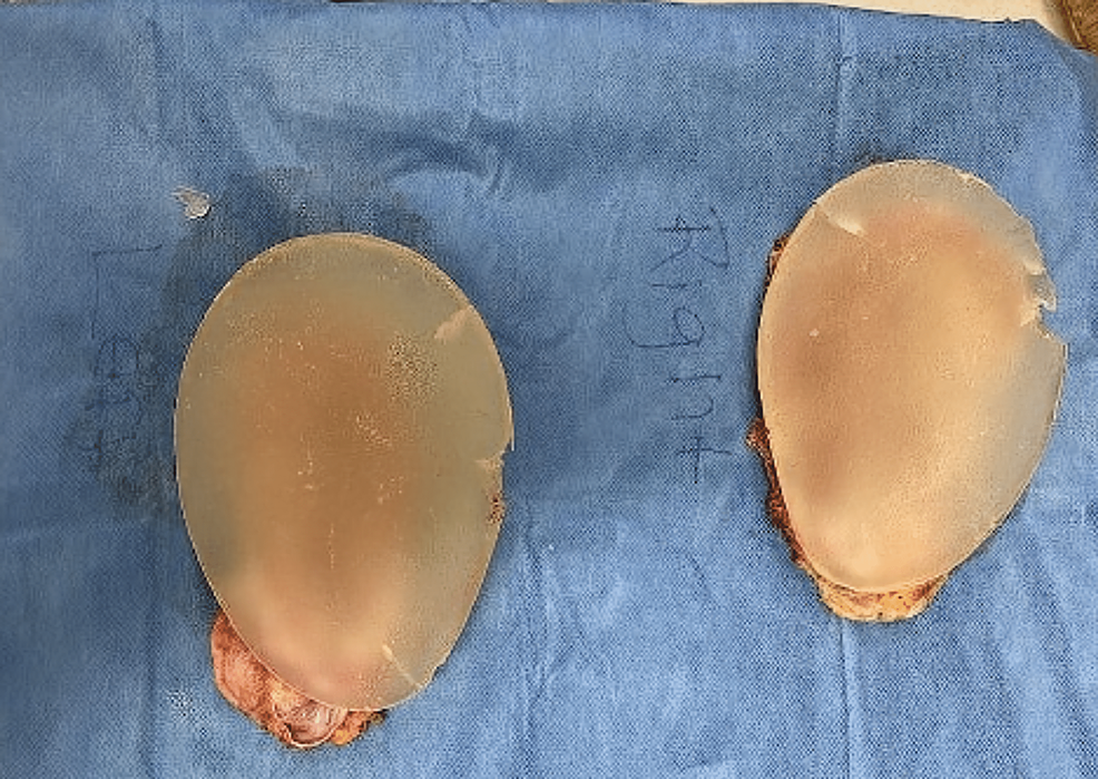 How the surfaces of silicone breast implants affect the immune