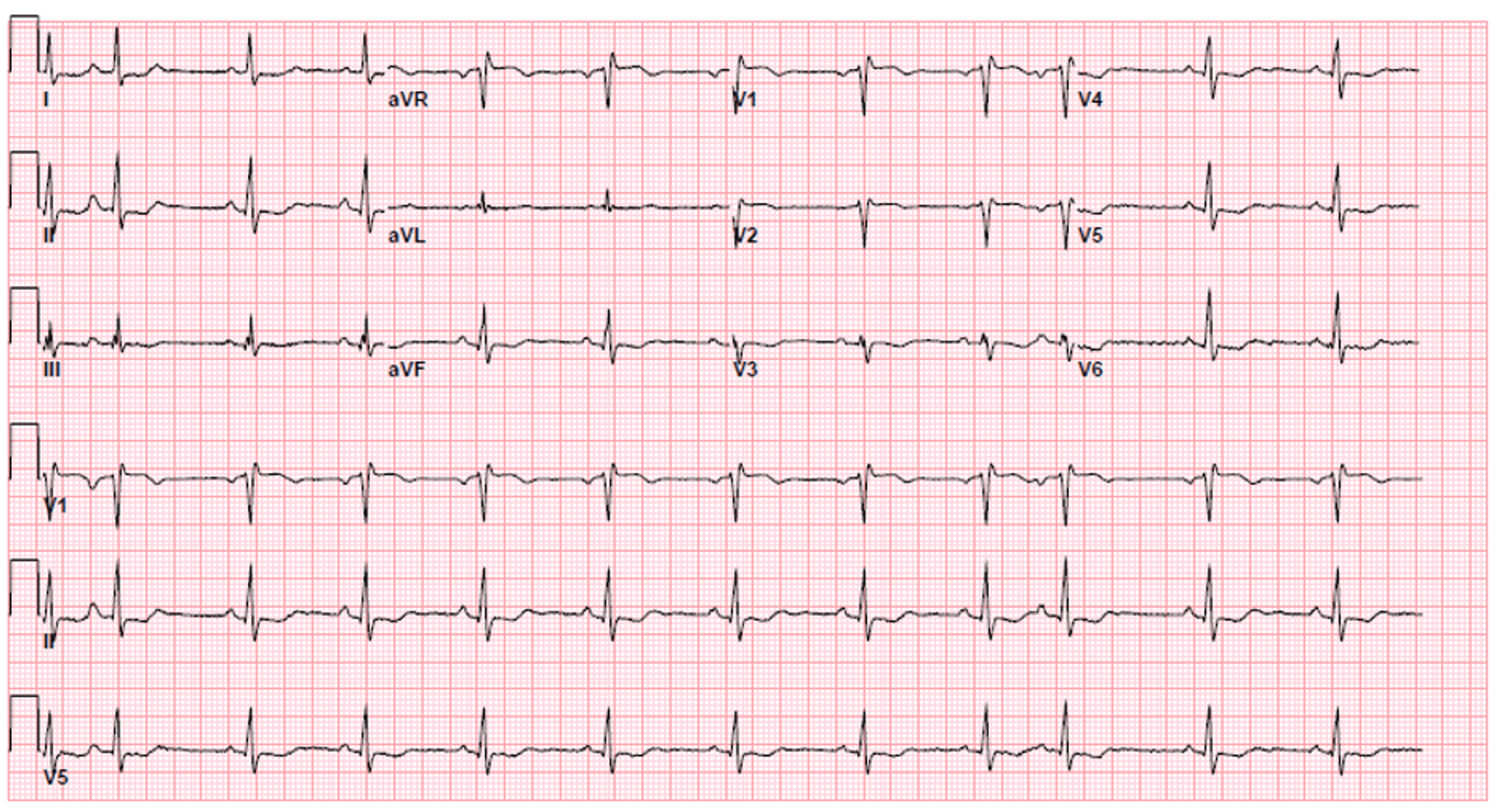 cureus-positive-regadenoson-stress-test-in-a-patient-on-phentermine