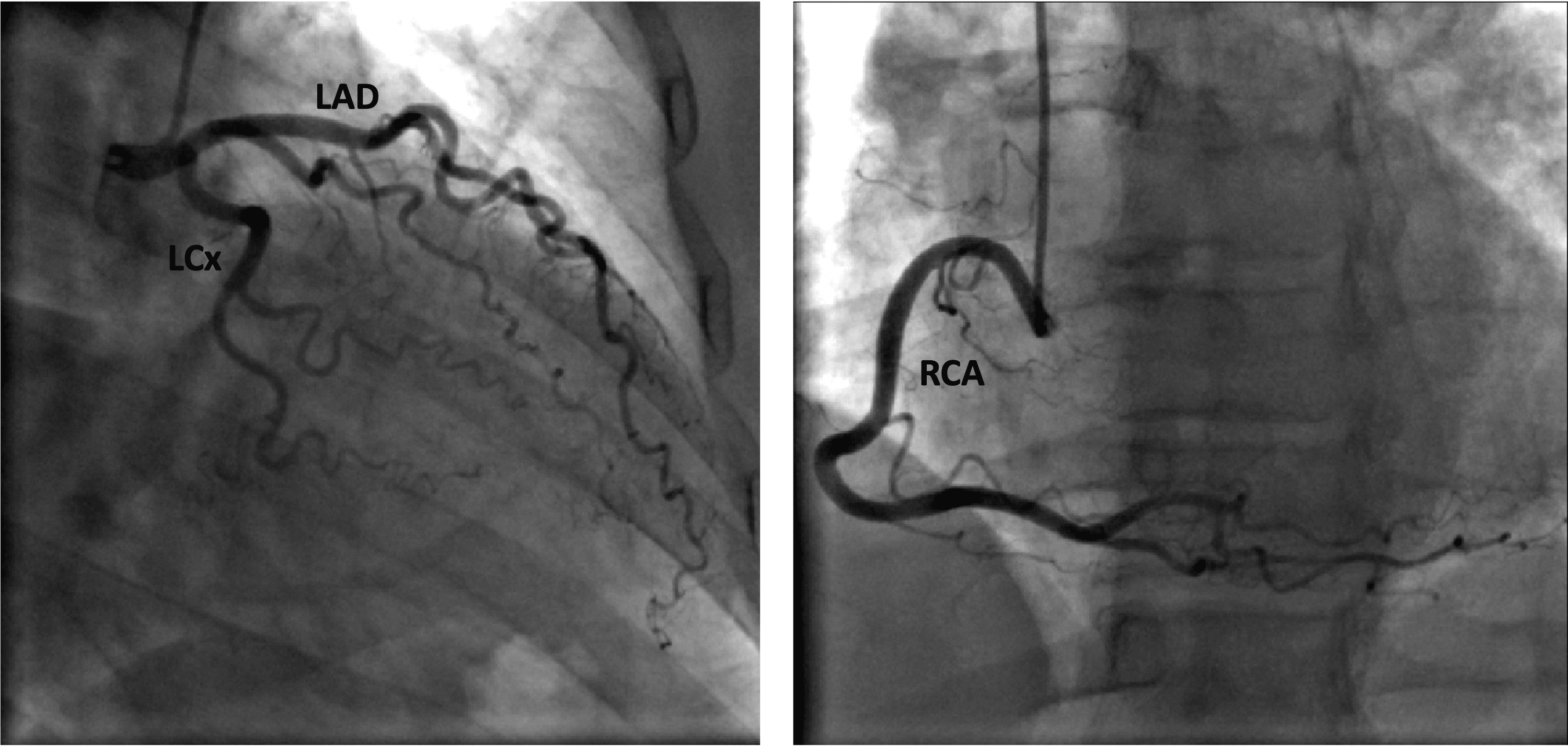 Cureus Positive Regadenoson Stress Test in a Patient on Phentermine With Normal Coronaries