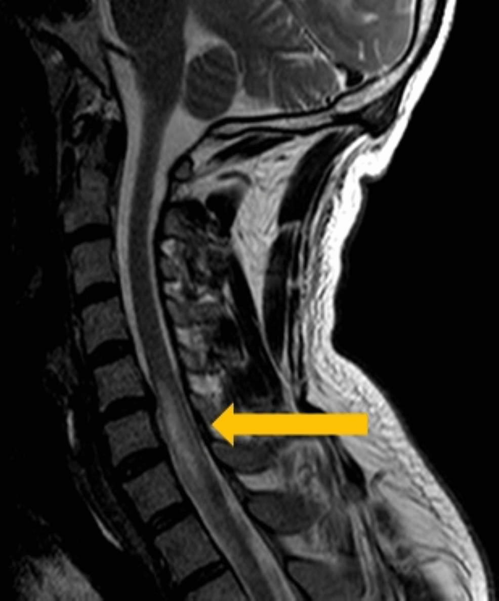 Magnetic-resonance-imaging-showing-a-spinal-cord-infarction-area-on-sagittal-view.