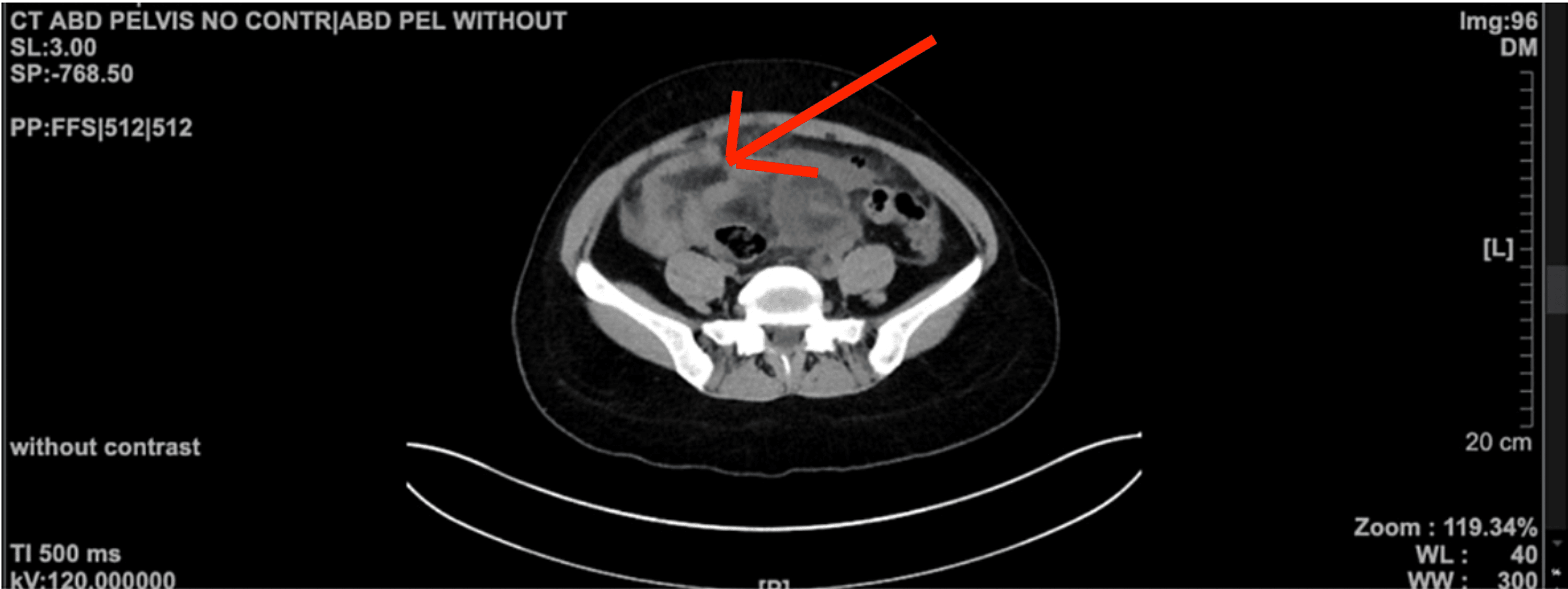 Cureus Intrauterine Contraceptive Device Complicated by a Pelvic