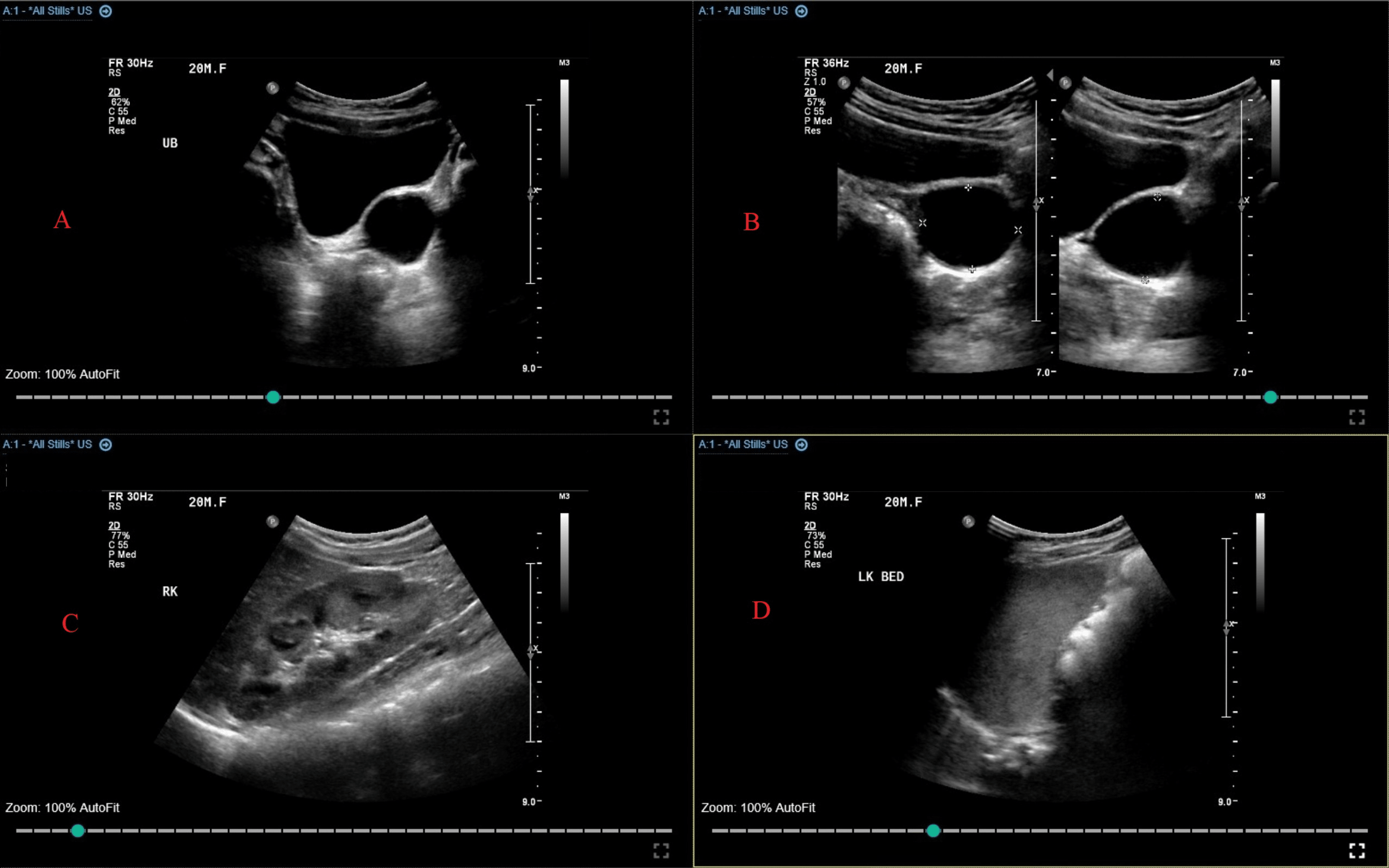 mullerian agenesis ultrasound