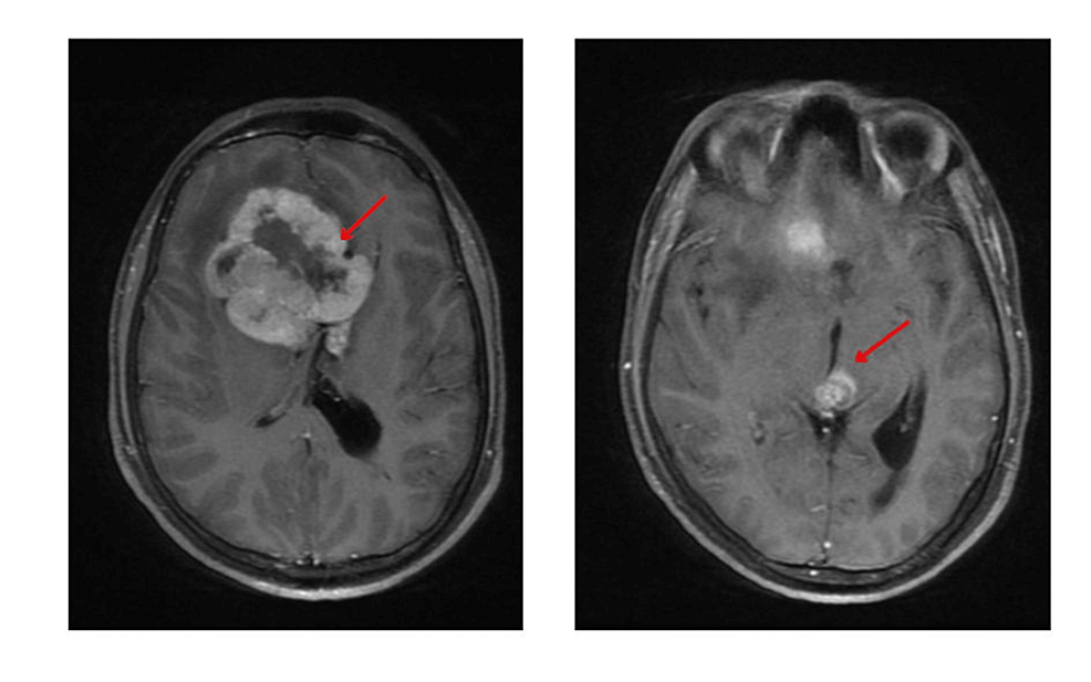 Cureus A Case of NonGerminomatous Germ Cell Tumors of the Frontal