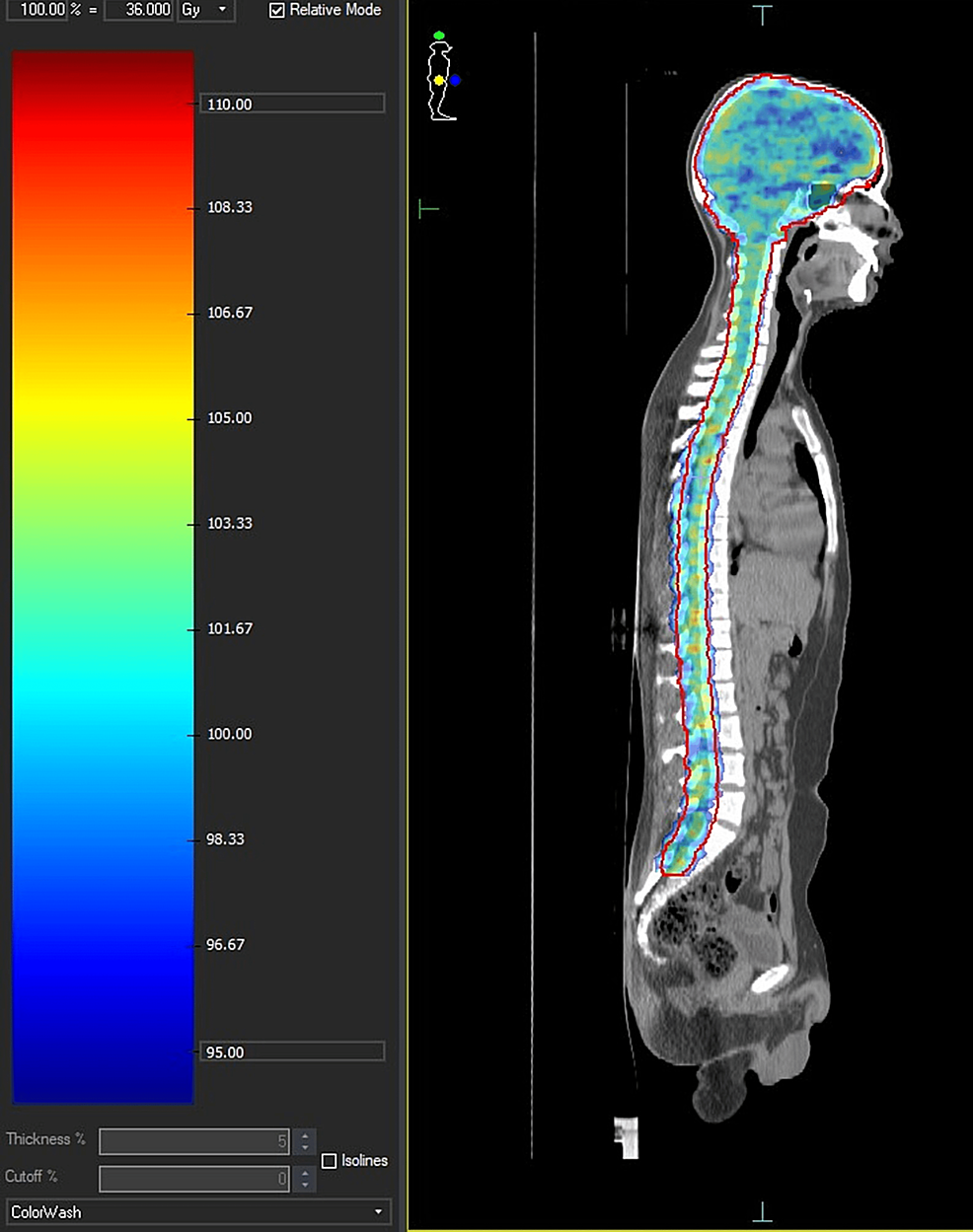 Craniospinal-radiation-showing-dose-distribution-in-color-wash
