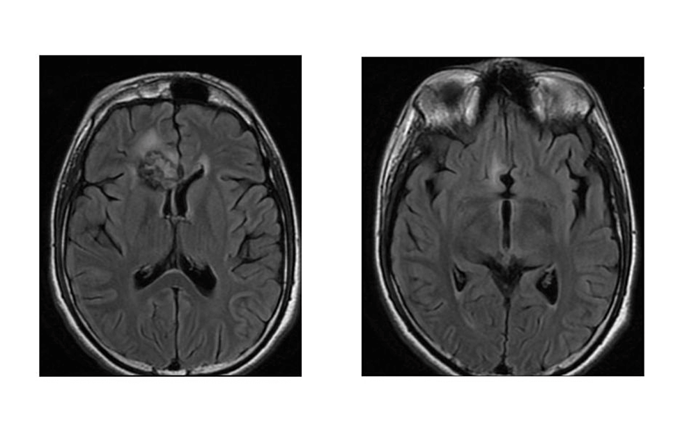 Post-treatment-MRI-imaging-showing-the-response-of-the-lesion