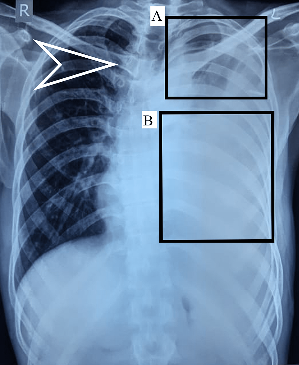 Chest-X-ray-of-the-patient-taken-in-the-posteroanterior-view-with-haziness-seen-over-the-left-upper-zone-(box-A)-and-consolidation-in-the-middle-and-lower-zone-(box-B)-with-mild-scoliosis-(arrow).