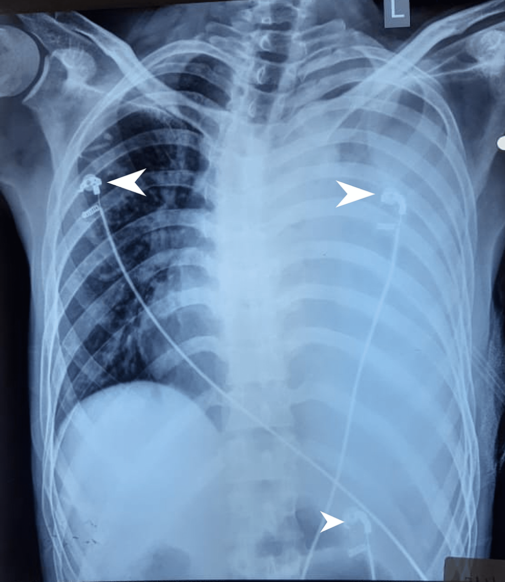 Chest-X-ray-taken-on-the-posteroanterior-view-with-the-intercostal-drain-in-situ.