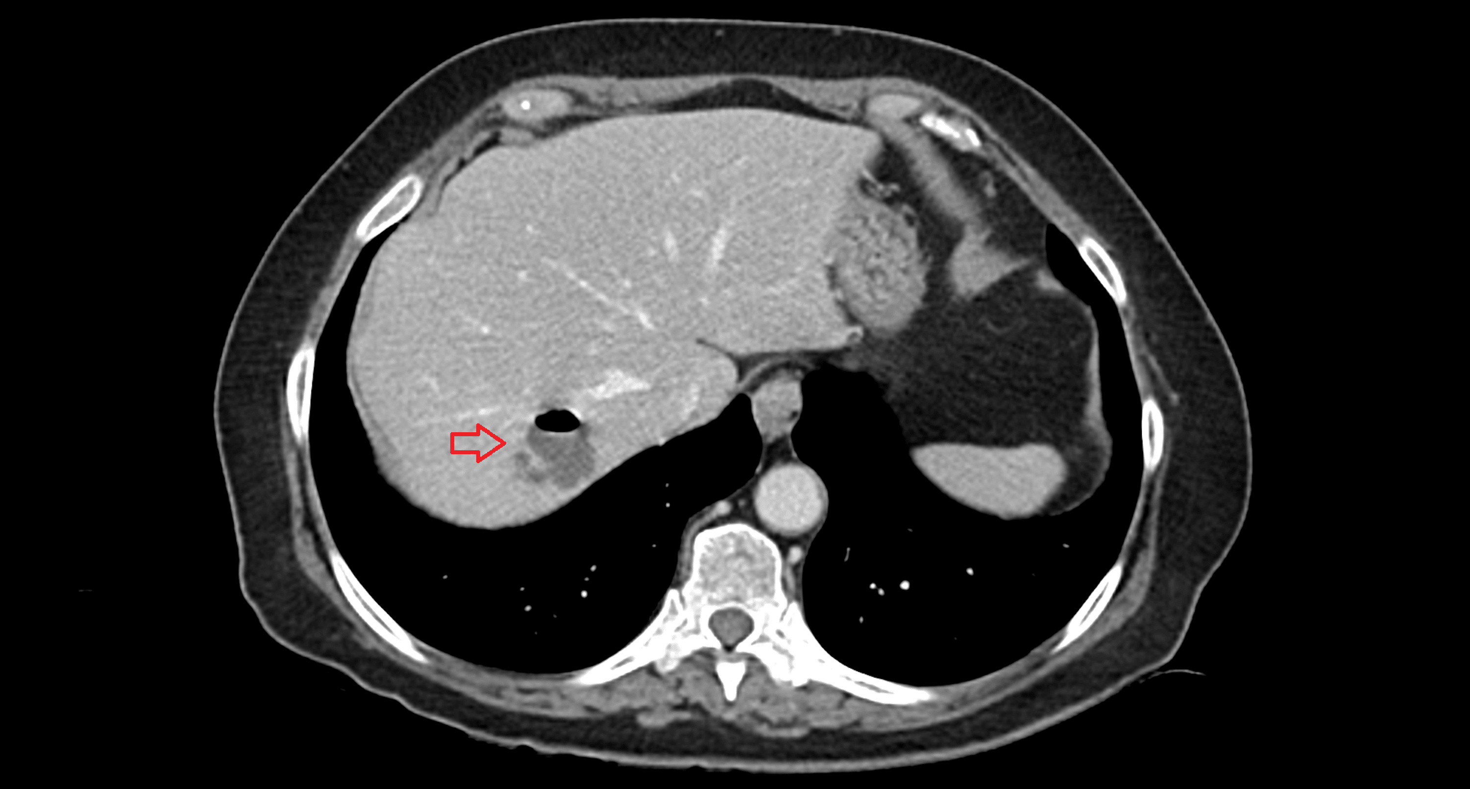 Cureus Pyogenic Liver Abscess and Delayed Massive Gastrointestinal
