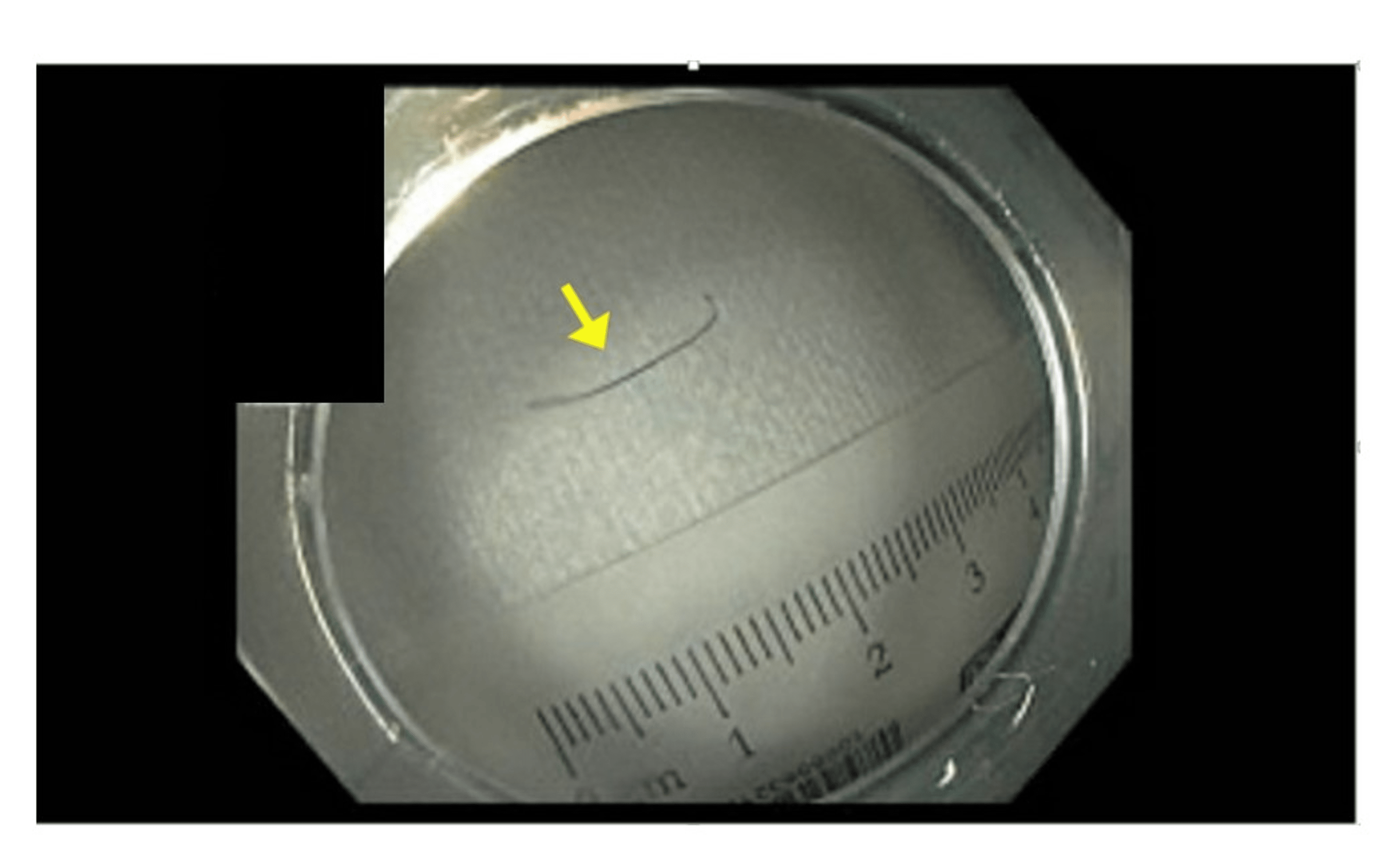 When It’s Not Pancreatitis, Don’t Brush It Off A Case Report of Small