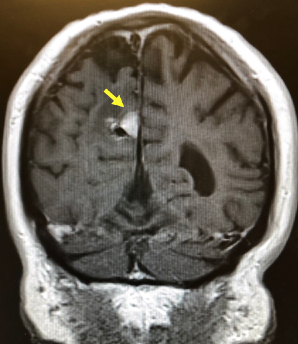 cureus-case-reports-of-pembrolizumab-induced-acute-inflammatory