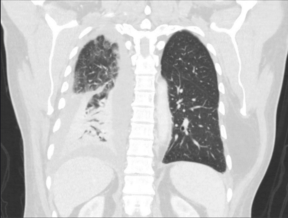 Cureus | An Uncommon Presentation of Pulmonary Tularemia: A Case Report ...