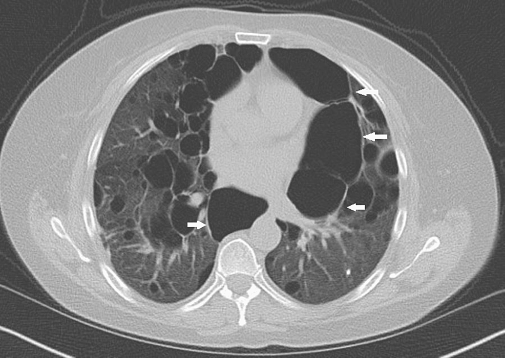 Cureus | Parotid Acinic Cell Carcinoma as a Presentation of Birt-Hogg ...