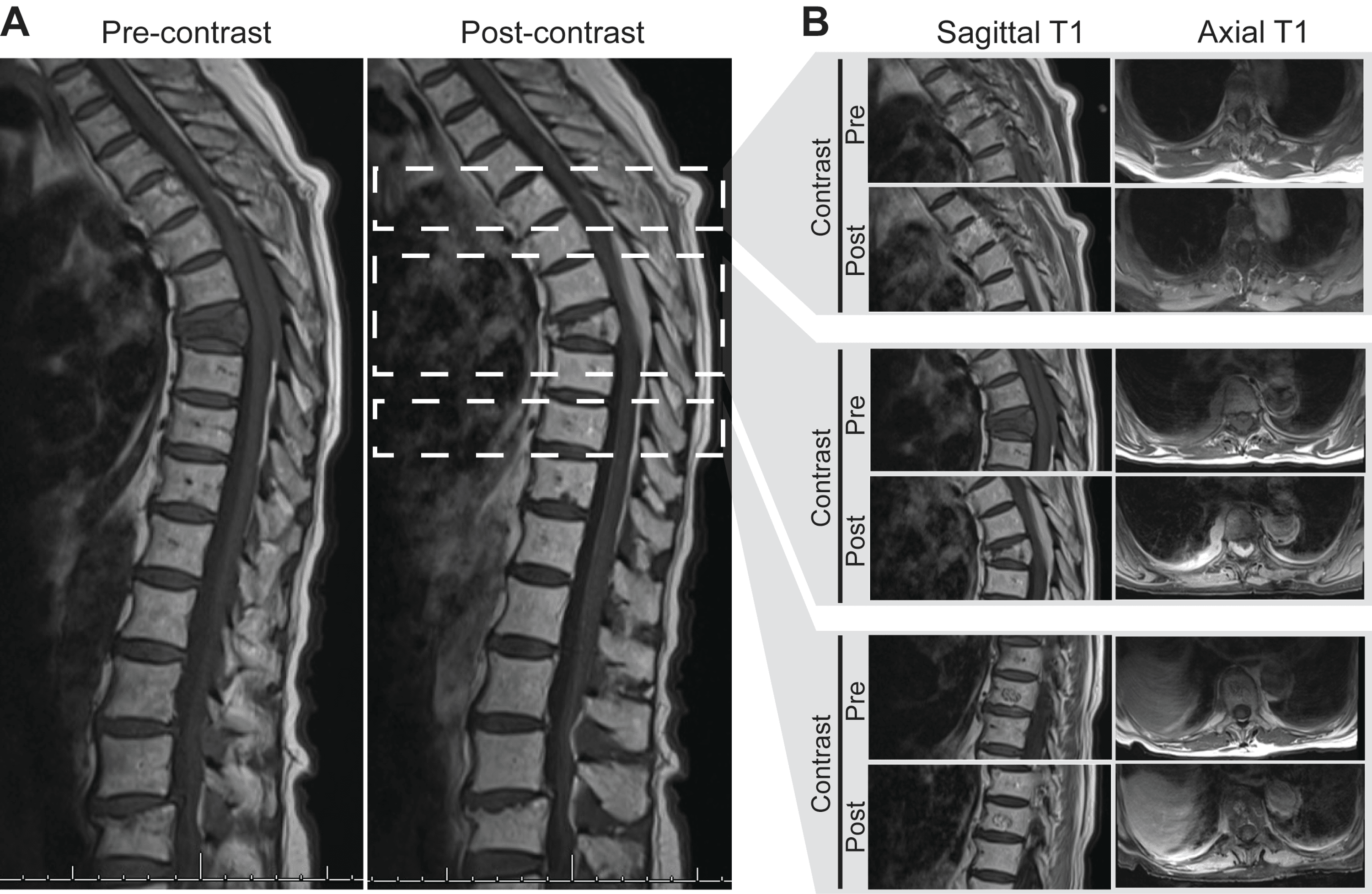 Cureus Spinal Lymphoma Presenting as an Epidural and Retropleural