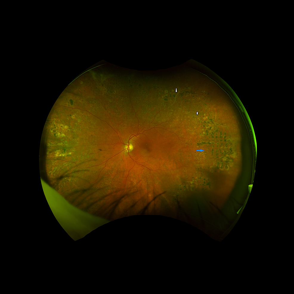 Optic Disc Neovascularization As The Only Sign Of Ocular Ischemic ...