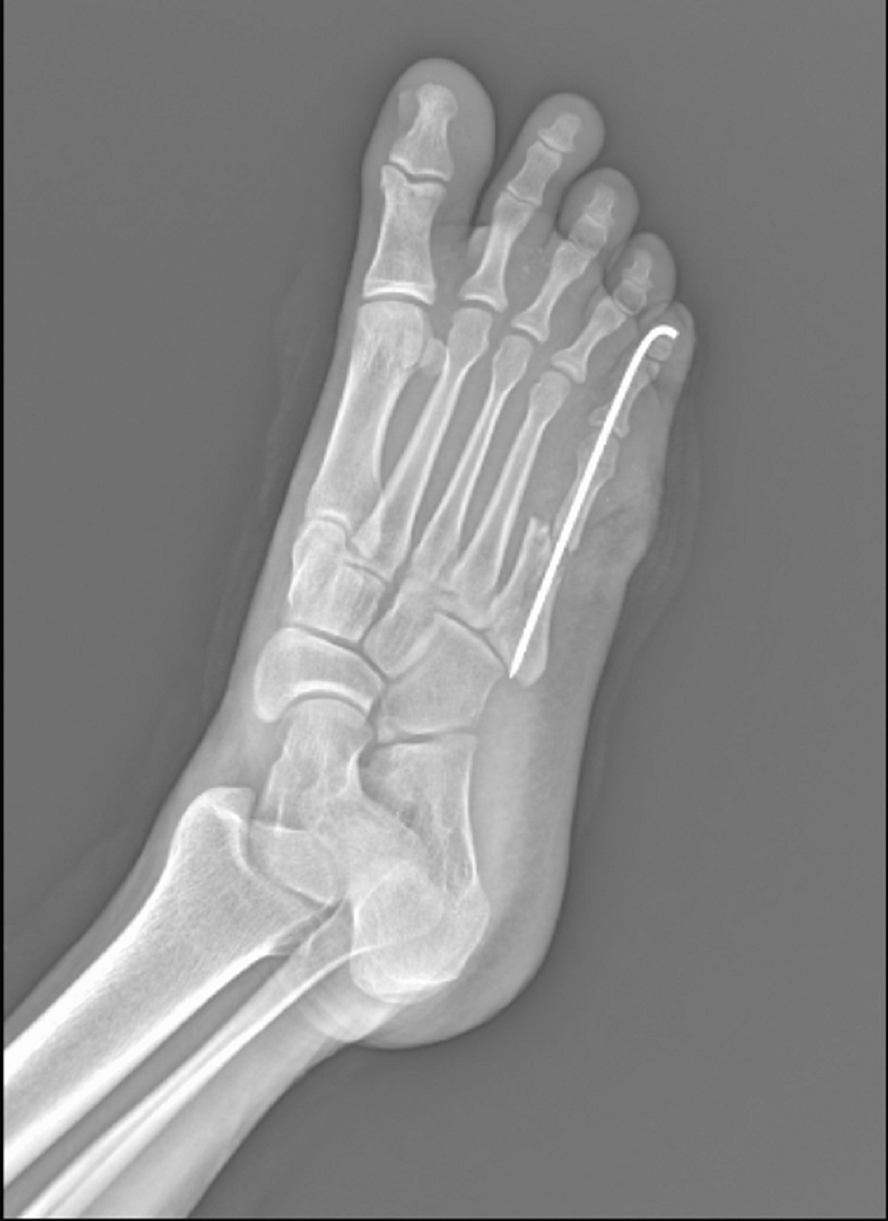 X-ray-showing-fifth-metatarsal-fracture-managed-with-K-wire-fixation---oblique-view