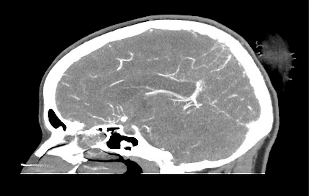 sagittal tomographic angiography with contrast agent