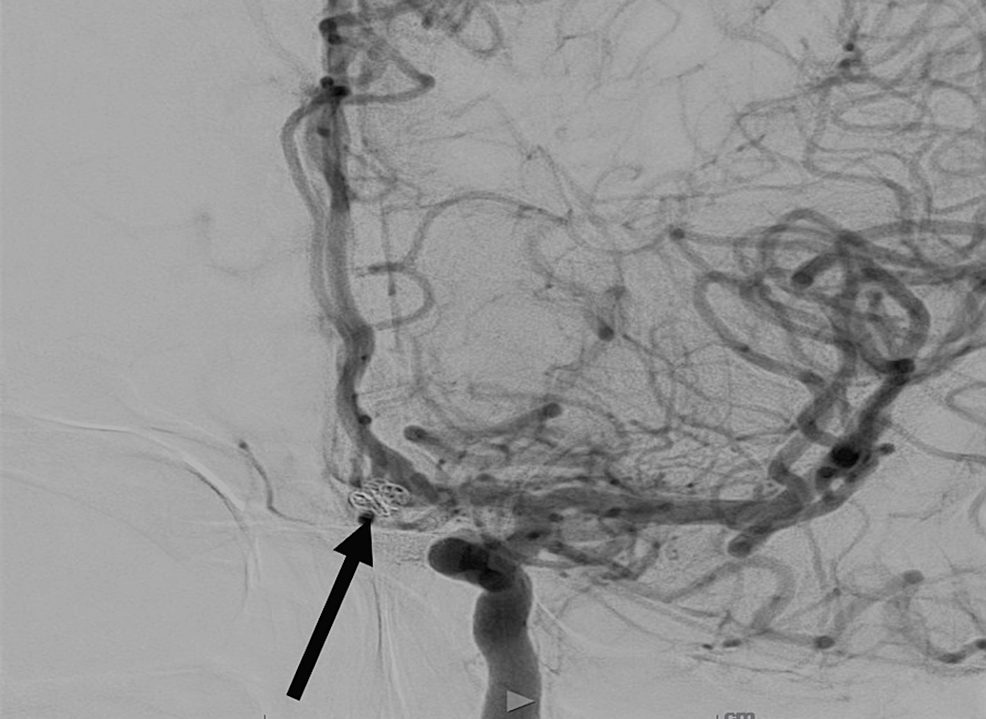 Coronary magnetic resonance angiography showing stable coiling
