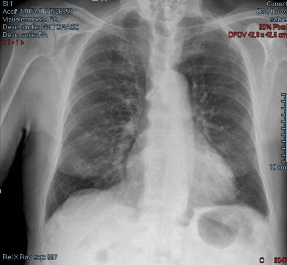 cureus-a-98-year-old-male-with-paroxysmal-atrial-fibrillation-treated