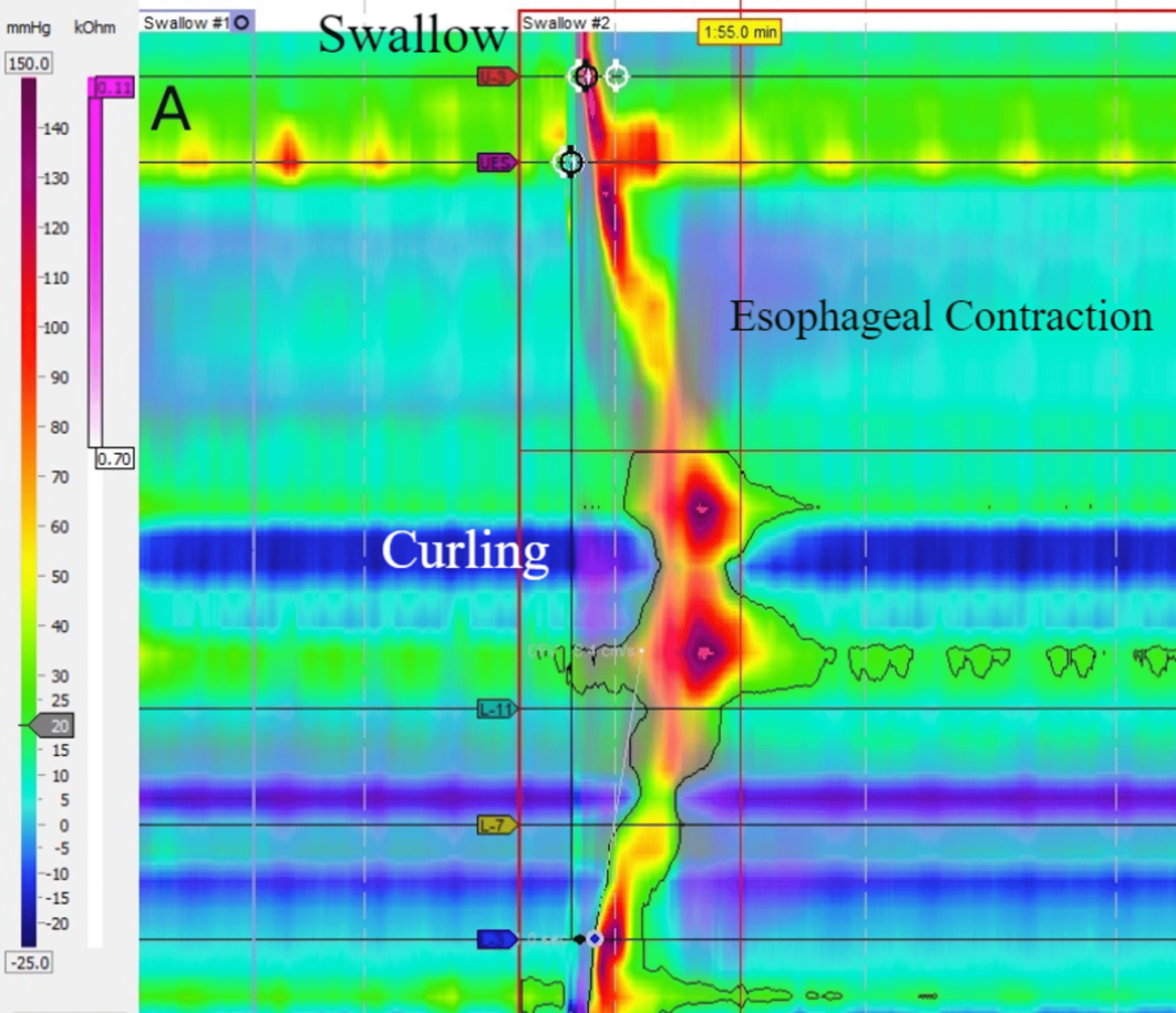 Cureus Butterfly in the Esophagus A Case Report on a Rare Esophageal