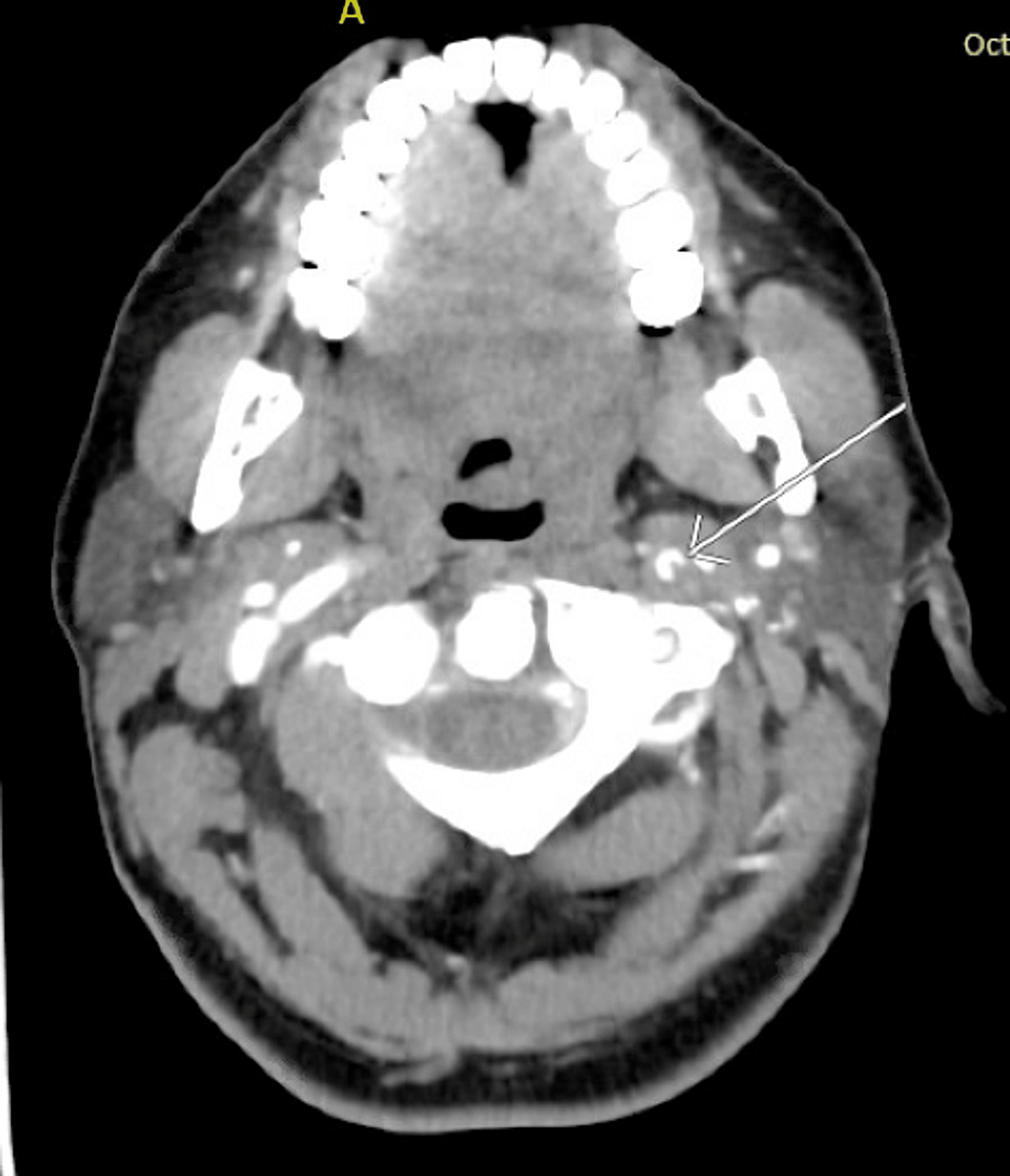 Cureus | Bilateral Carotid Artery Dissections and Ischemic Stroke in a ...