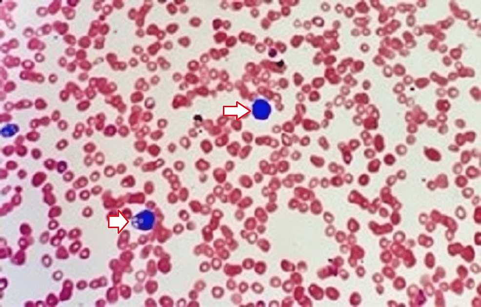 hemophagocytic-lymphohistiocytosis-after-greenlight-laser-prostate