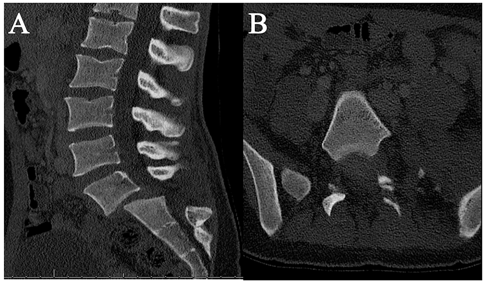 cureus-pediatric-bilateral-lumbosacral-dislocation-without-fracture