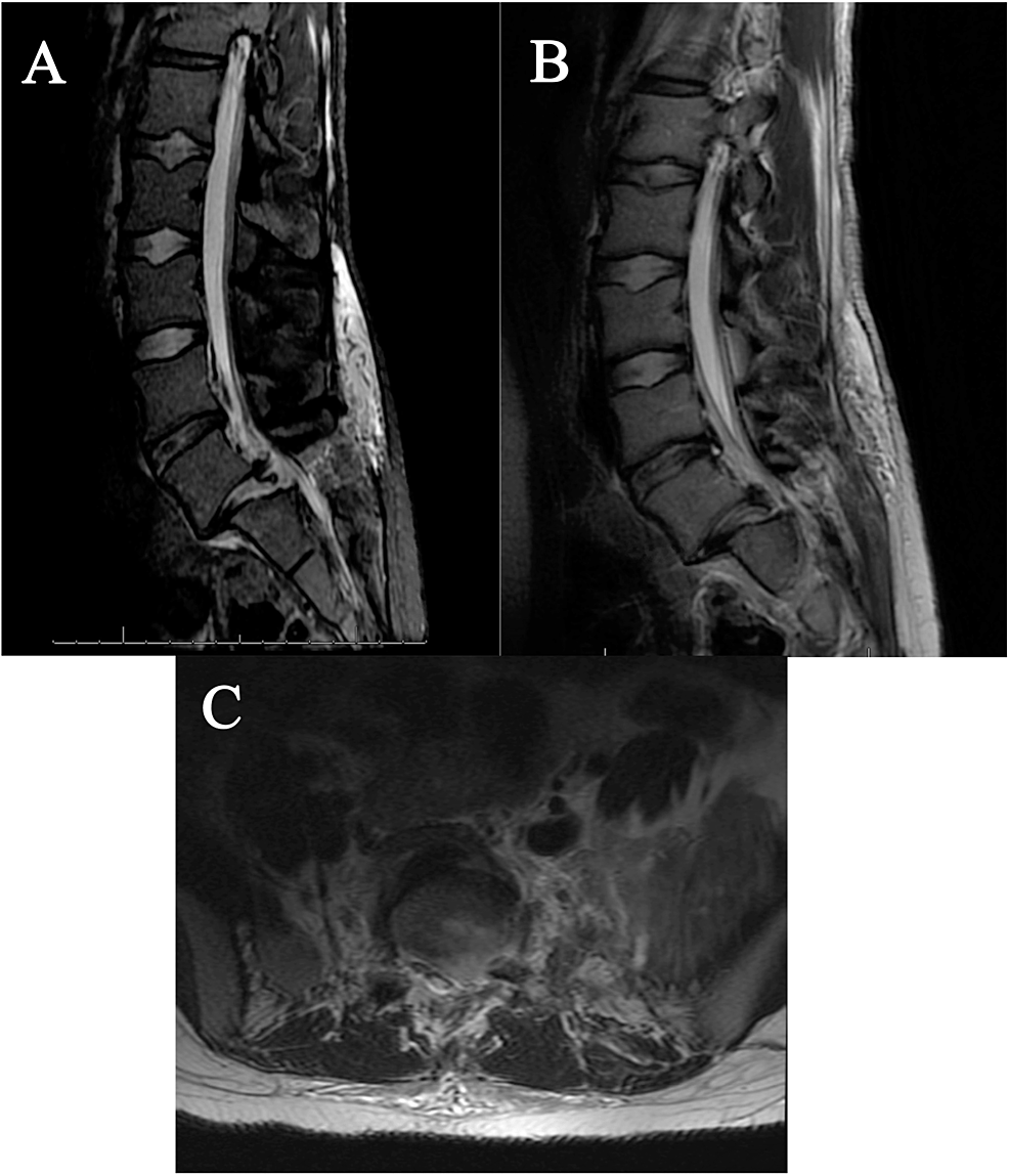 Cureus | Pediatric Bilateral Lumbosacral Dislocation Without Fracture ...