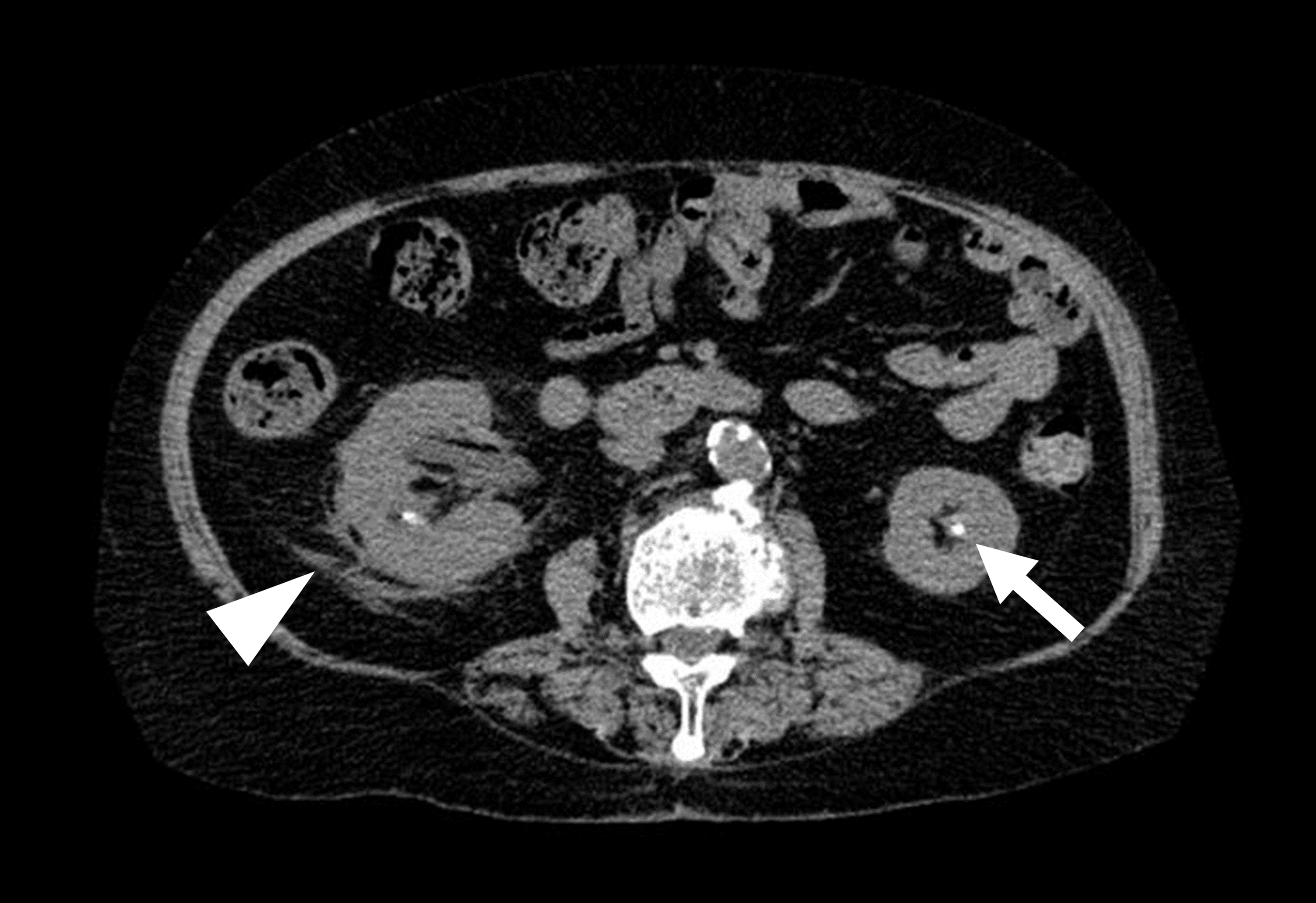 Cureus | Septic Shock Due to Urinary Tract Infection in an ...