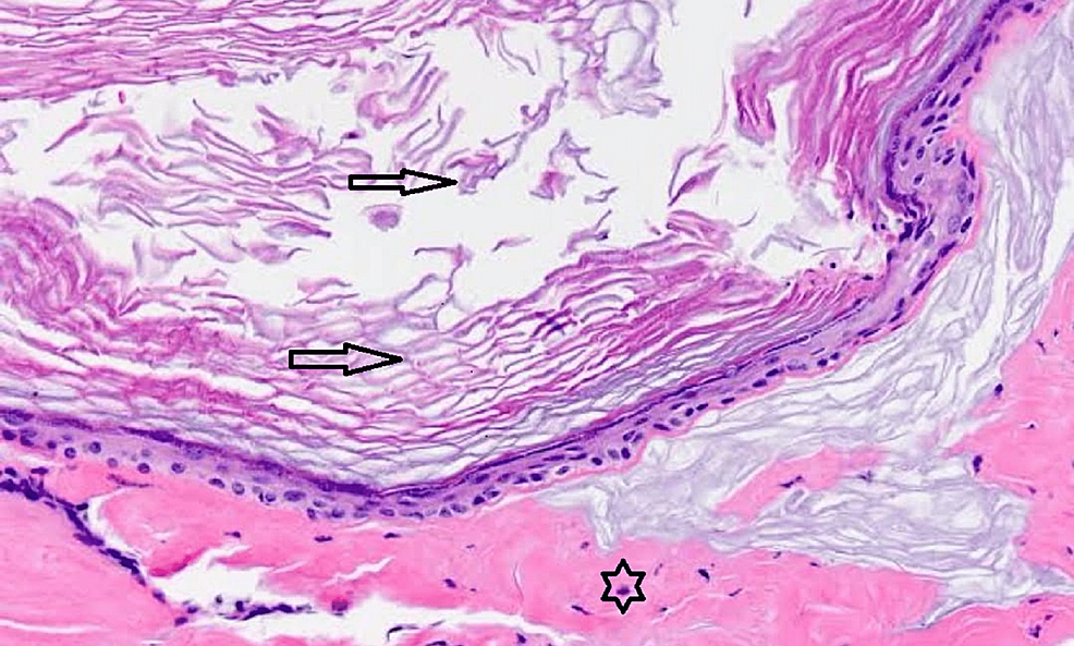 Histopathological findings show - loose - keratin - flakes - (black arrow) - and - epidermis - (asterisk).