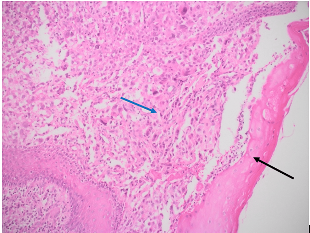 Epithelioid Type Tongue Rhabdomyosarcoma In A Pediatric Patient A Case