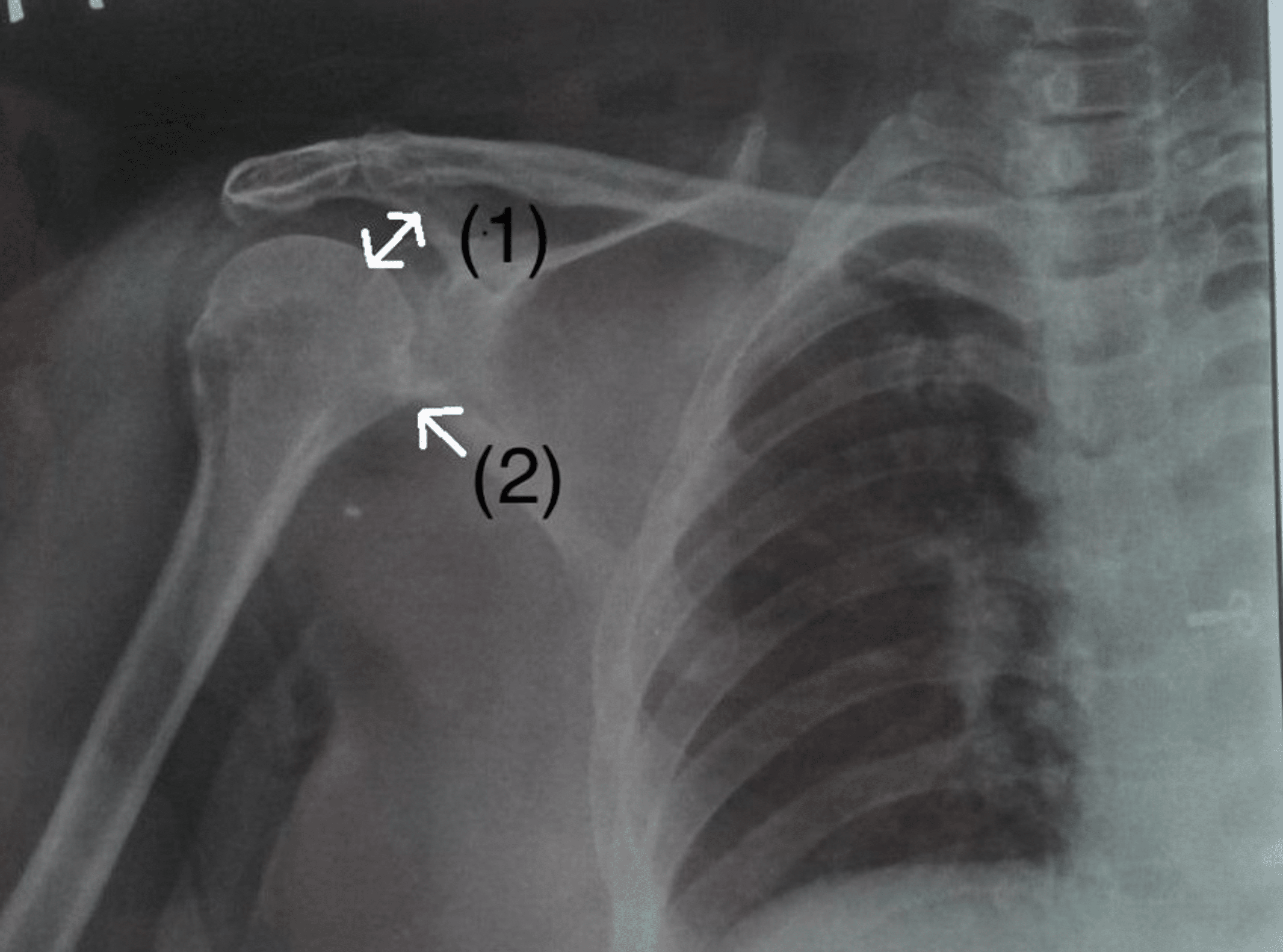 Cureus “Gongs Mobilization “Approach for Frozen Shoulder