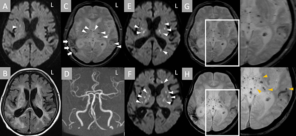 Cureus, Brainstem and Spinal Arachnoiditis Ossificans Associated With  Neurocysticercosis: A Case Report