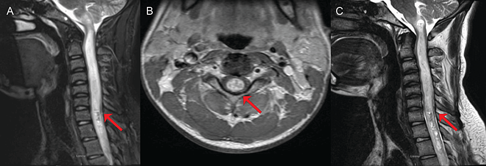 cureus-primary-spinal-glioblastoma-mimicking-neuroschistosomiasis-a