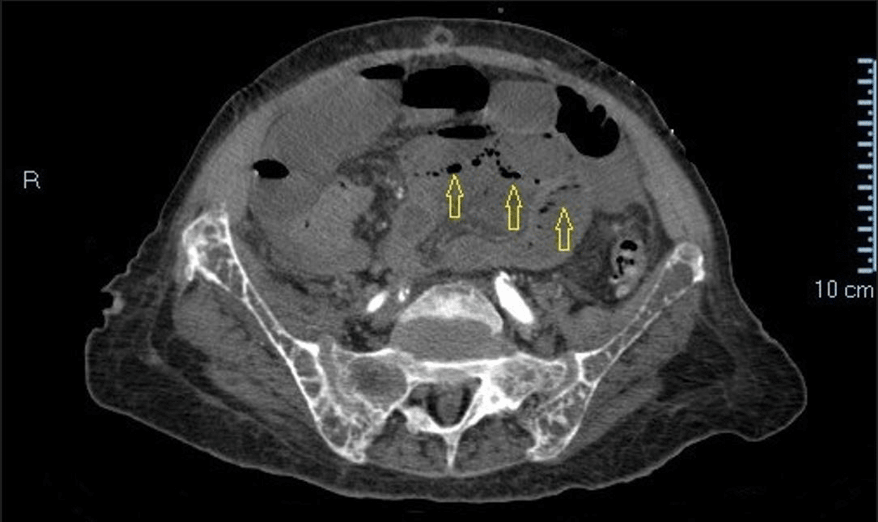 Cureus A Rare and Severe Cause of Abdominal Pain in a Hemodialysis