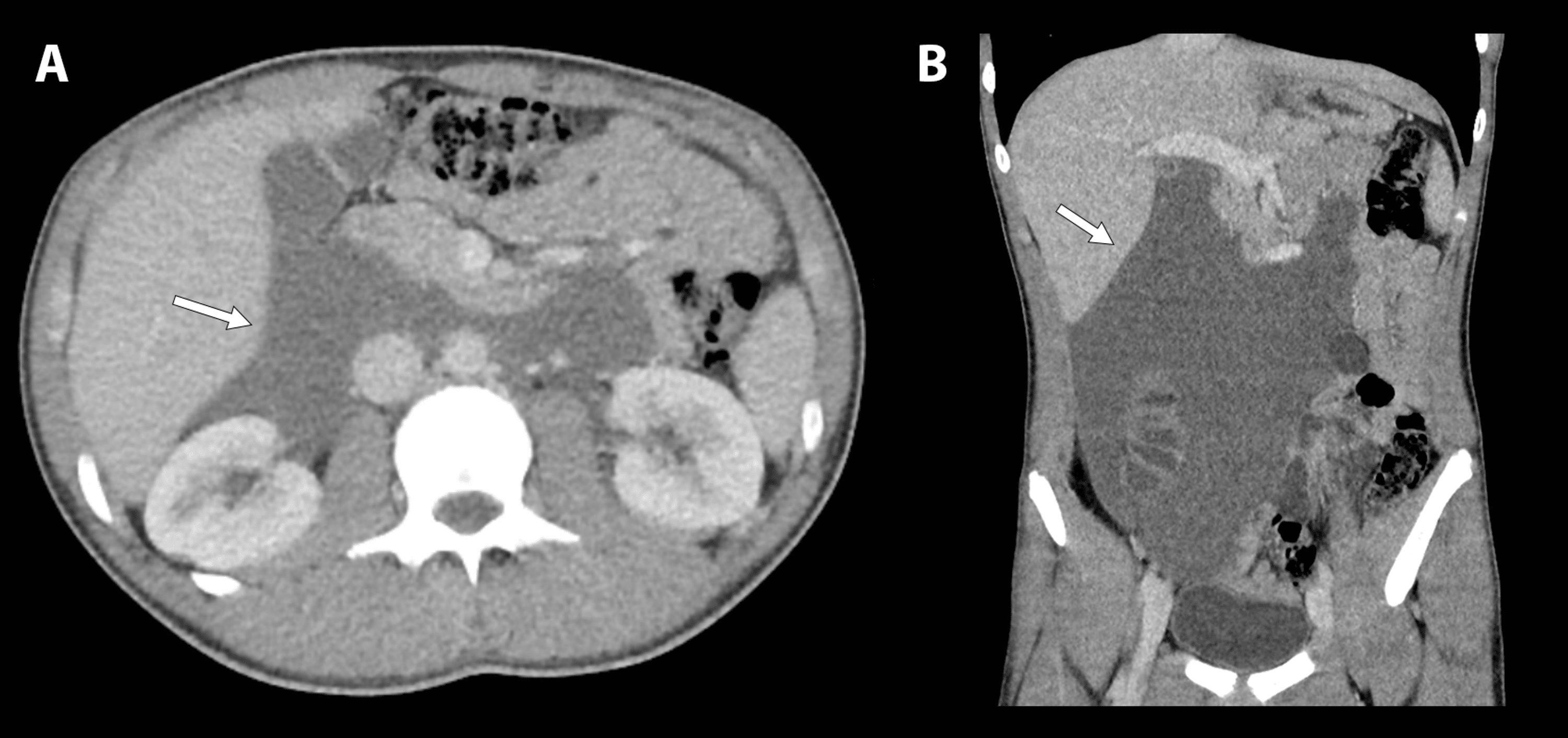 Cureus | Recurrent Retroperitoneal Lymphatic Malformation in a Pediatric  Patient: A Case Report
