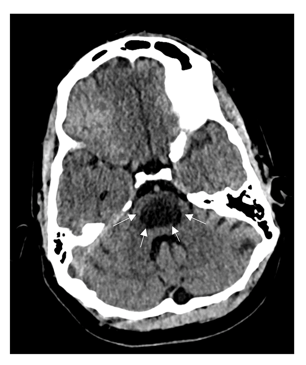 Single axial CT head at second admission 5 weeks later shows weak central attenuation in the lower bridge (between white arrows)