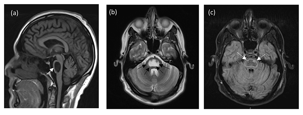 MRI-brain:-sagittal-T1